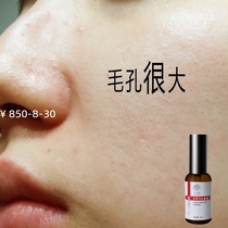 Nine-leaf grass shrinking pore essence Blackhead removal cleaning set Horny nose thickening repair firming artifact
