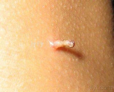 丝状疣特效去除 颈部脖子面部腋下扁平疣寻常疣肉刺瘊