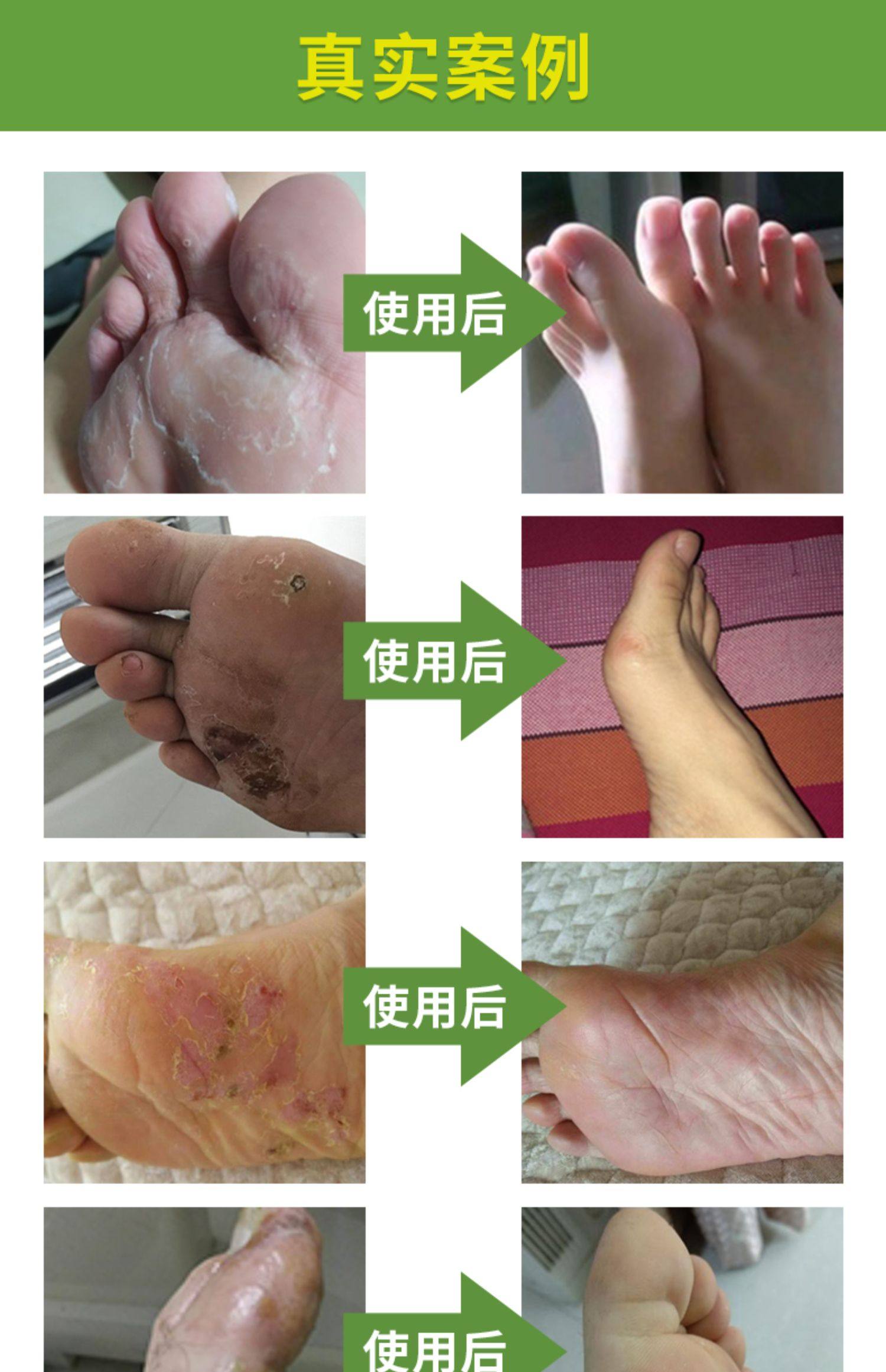 脚臭粉脚汗泡脚药包除脚臭喷雾剂止除汗神器汗治脚出汗克星男女士