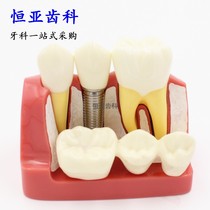 Dental 4 times planting solution model denture dental implant illustrated removable bridge Crown planting mode