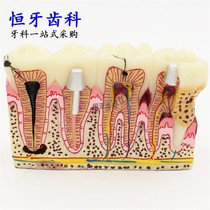 Dental model implant decomposition model oral materials teaching model dental implant model special offer