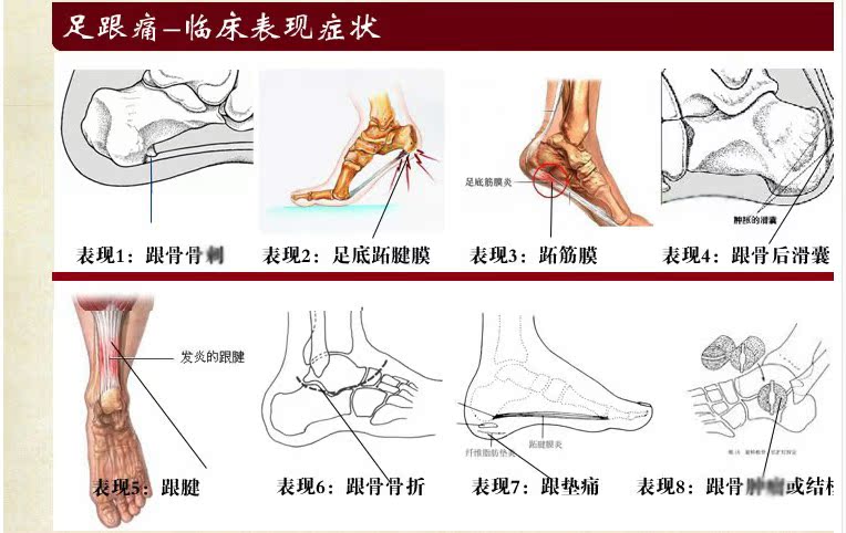 适用于足底筋膜炎,颈肩腰背肌筋膜炎,臀部小腿肌筋膜炎,足跟疼,足跟骨