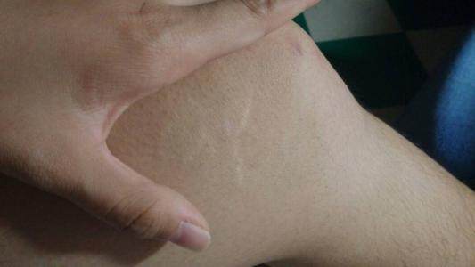 为什么会长肥胖纹, 你有肥胖纹吗