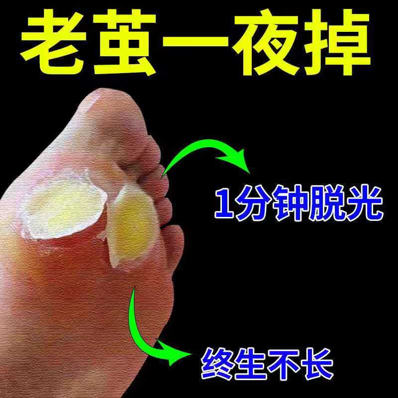 Go to the foot cocoon dead skin foot thick cocoon old cocoon corn eye hand cocoon removal artifact meat thorn foot cocoon softener wart plantar wart