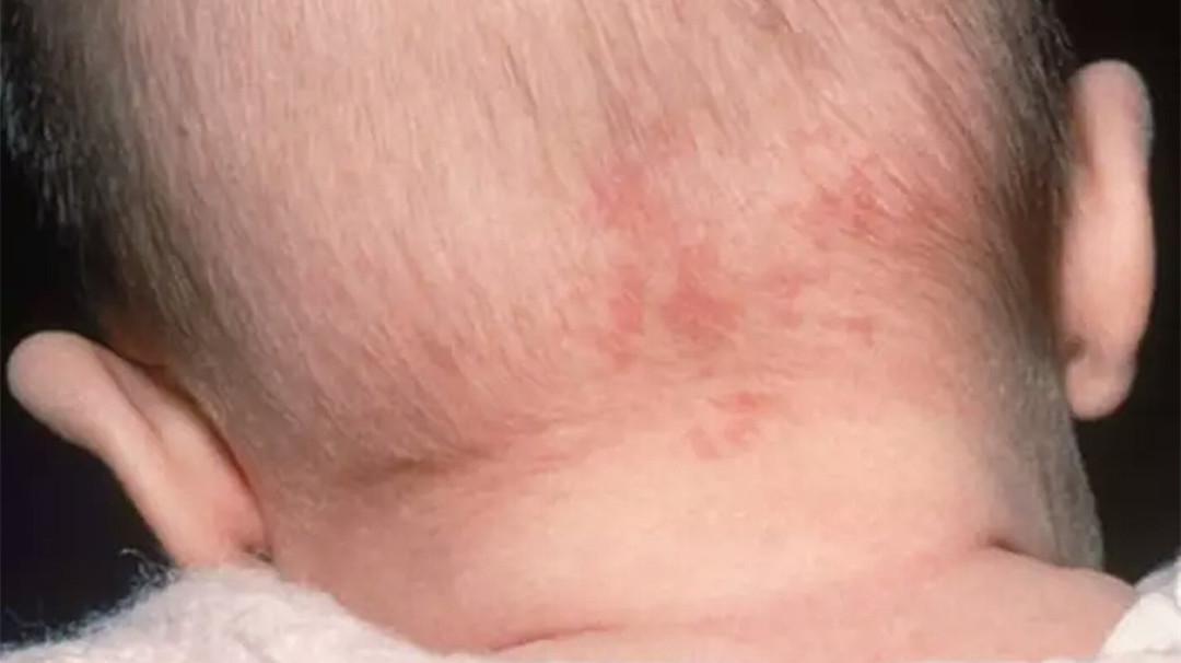 如果宝宝的胎记长成这样?妈咪你要当心了