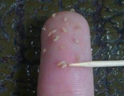 长时期堆积,毛孔油脂慢慢堆积成型,变成颗粒状