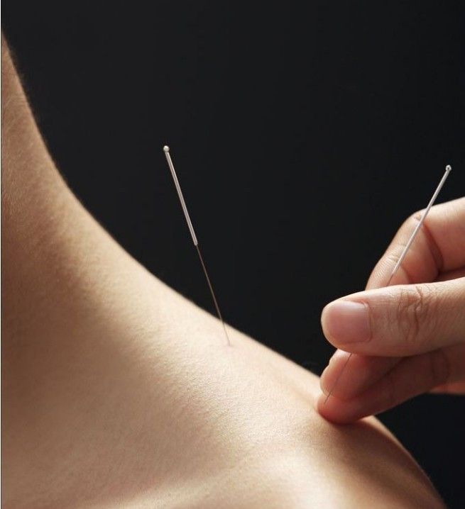 传统针灸减肥,美容又美体