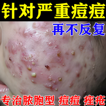 Acne Cream Acne Severe Acne Mens Acne Printing Acne Pit Repair Lymphatic Acne Cheek Acne Swelling Nodules Hard Block
