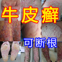 Hand ringworm topical fungal infection psoriasis sweat herpes Moss ointment silver cuttings special neurodermatitis to eradicate