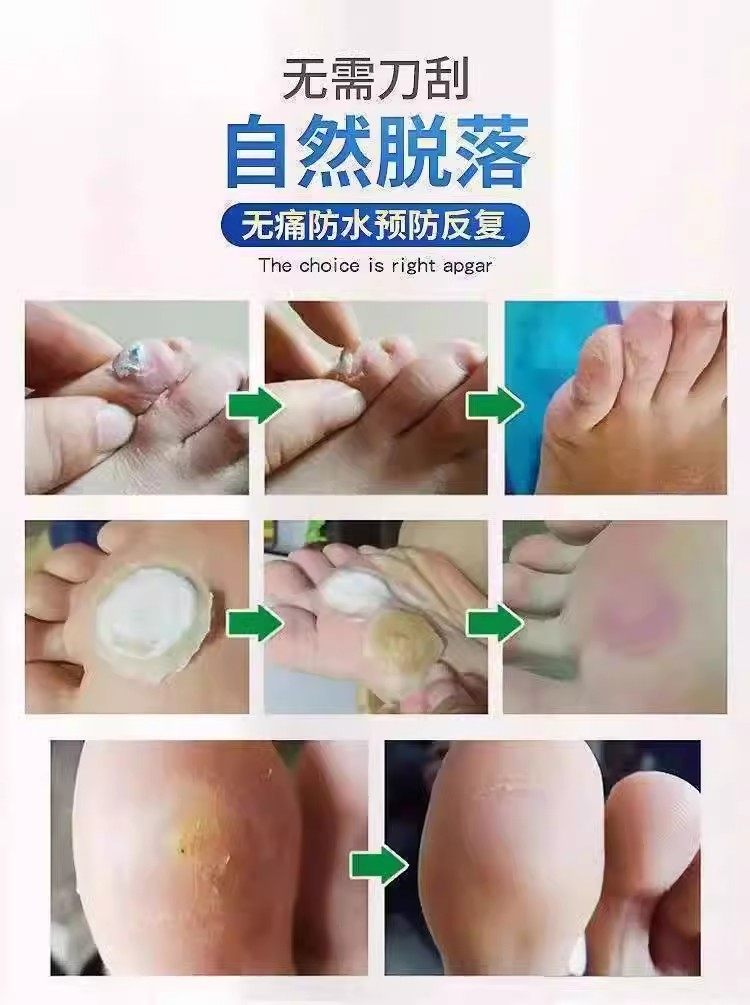 鸡眼抑菌液滁脚趾手指鸡眼肉刺顽固除反复生长