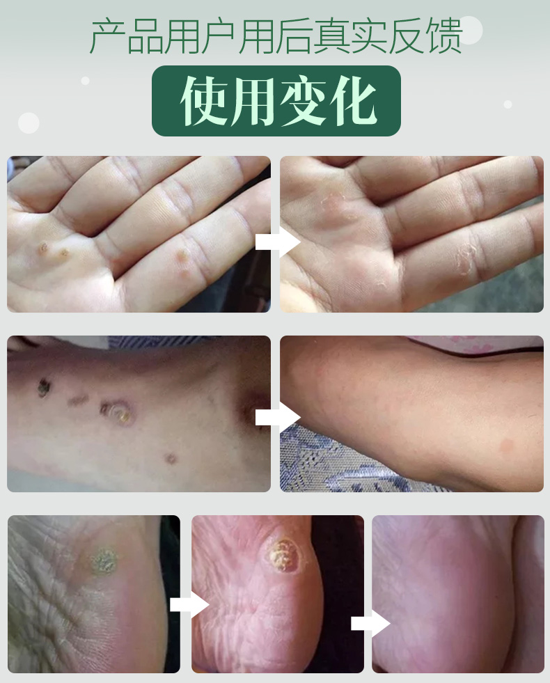u博士正品疣瘊子净跖疣膏鸡眼药去除刺猴根专用去疣灵足部手肉刺