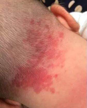 鲜红斑痣也称为葡萄酒色痣,是血管瘤的一种,发病率较高,为23.4～40.