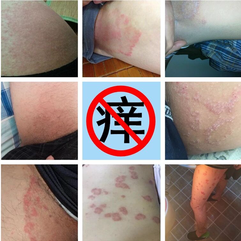 淘宝肤毒清治疗皮肤病过敏止痒药膏