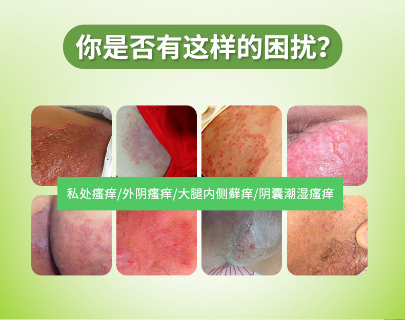 外阴瘙痒止痒膏女性私处抑菌外用肛门阴囊潮湿大腿