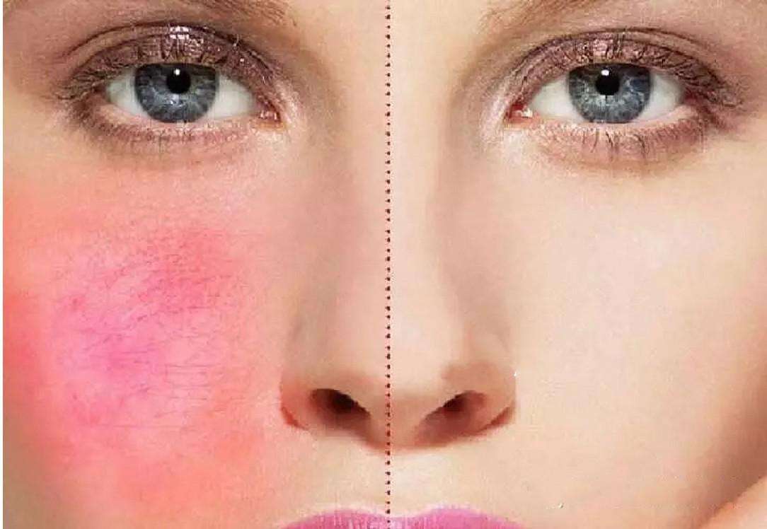 去面部红血丝,4个方法看似复杂却很简单