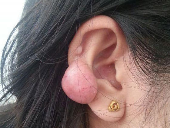 耳洞反复发炎红肿?你的耳钉戴对了吗