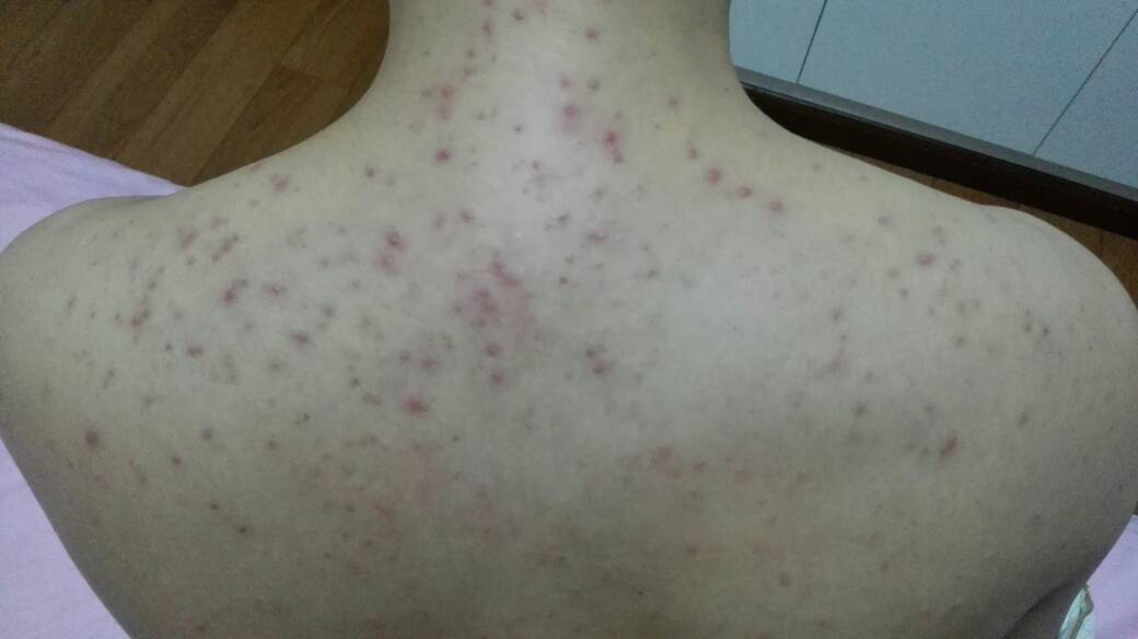 后背长痘一定要进来看特别是女生