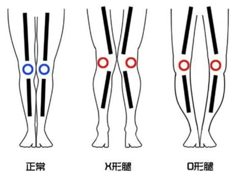 一, 什么是x型腿和o型腿?