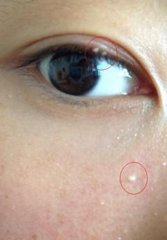 为什么眼睛周围总是长脂肪粒?去得掉吗?