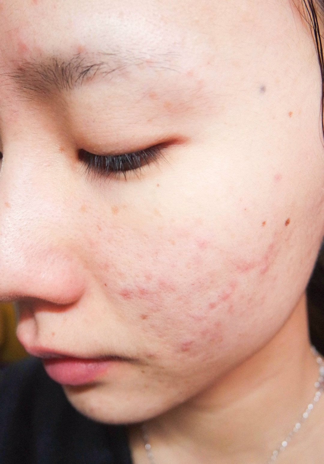 资深痘肌和你们来聊聊我的皮肤调理经历