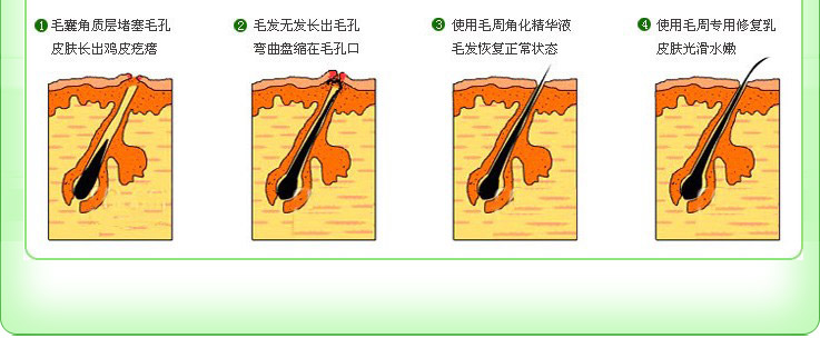 鸡皮肤因素(1)这是一种遗传性皮肤病,它是由于毛囊口角化,影响了毳毛