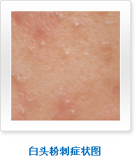 白头粉刺型痘痘