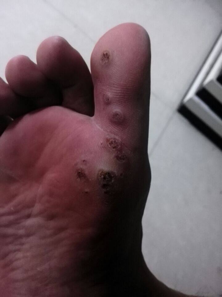 周氏去瘊灵膏 刺猴 跖尤 猴子 休子肉刺寻常 甲周 扁平