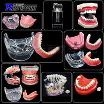 Dental model implant restoration explanation teaching dental model dental preparation orthodontic model oral model