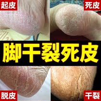 Foot peeling dry cracking dry peeling cracked skin cracked skin summer molting heels non-exfoliation non-repair cream