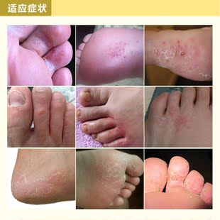 雨顺堂脚气灵套装包邮