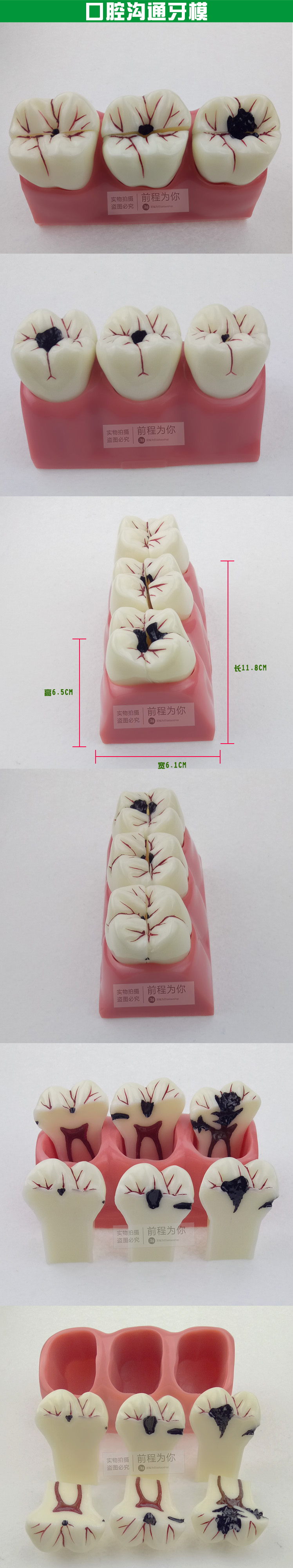 牙齿蛀牙模型龋齿演示发展模型口腔诊所医患通模型牙科教学模型 磊