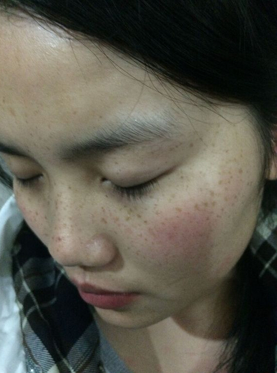 斑龄:7年 年龄26 以下照片为患者实拍 清晰度无法相同 保证全部为真实