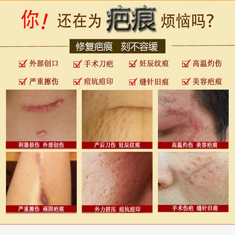泰国喜疗疤10g凹凸手术伤疤剖腹产伤烫痘印坑疤痕修复膏 儿童