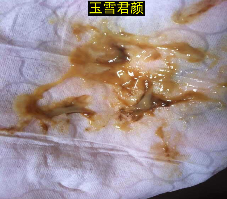 玉雪君颜 阴道清毒宝白带异味私处护理抑菌清宫丸妇科