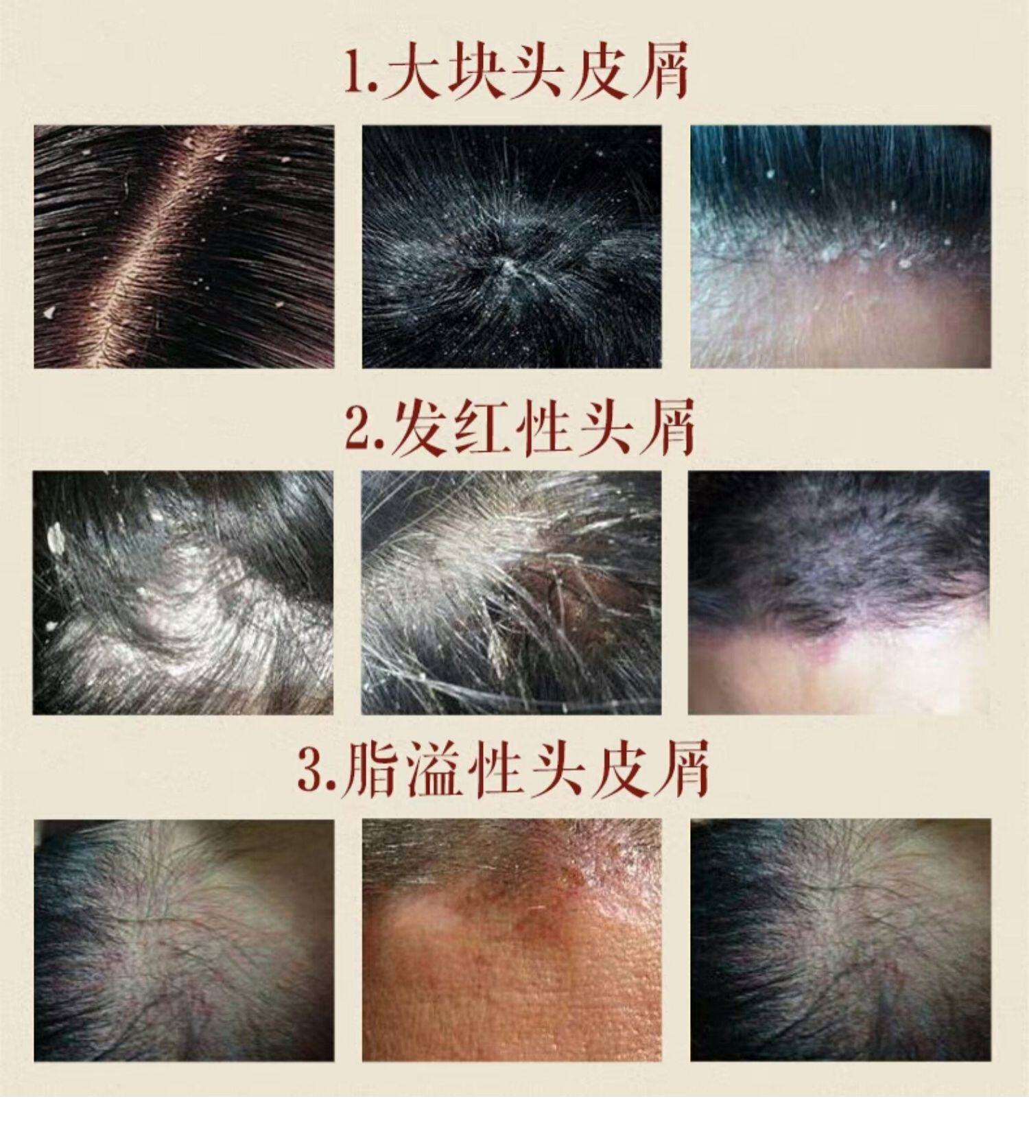 伊芙特煤焦油抑菌洗液去屑止痒脂溢性头屑克星神器洗发水头痒除螨