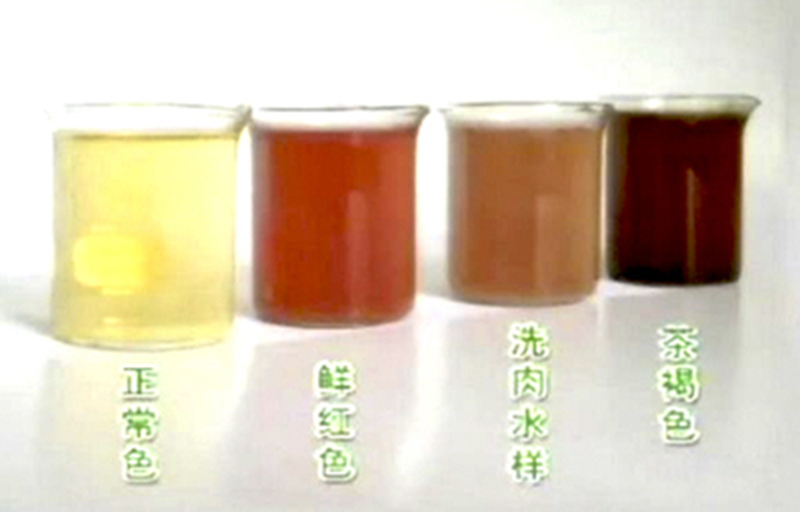 男童排出"酱油尿",未想竟是这个在作妖
