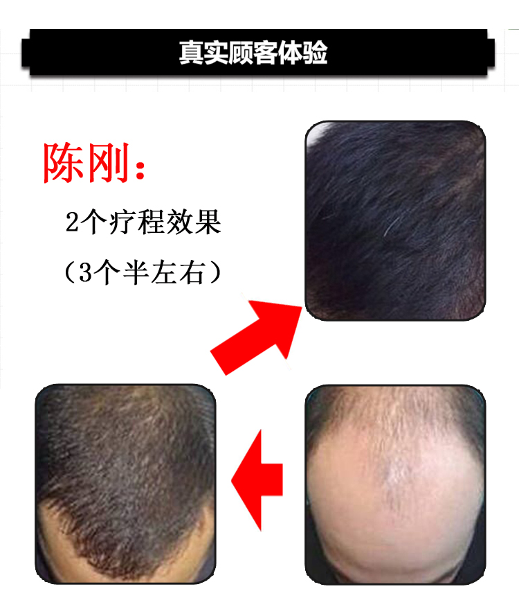 【无效我吃掉】 头发3-5倍自然生长速度