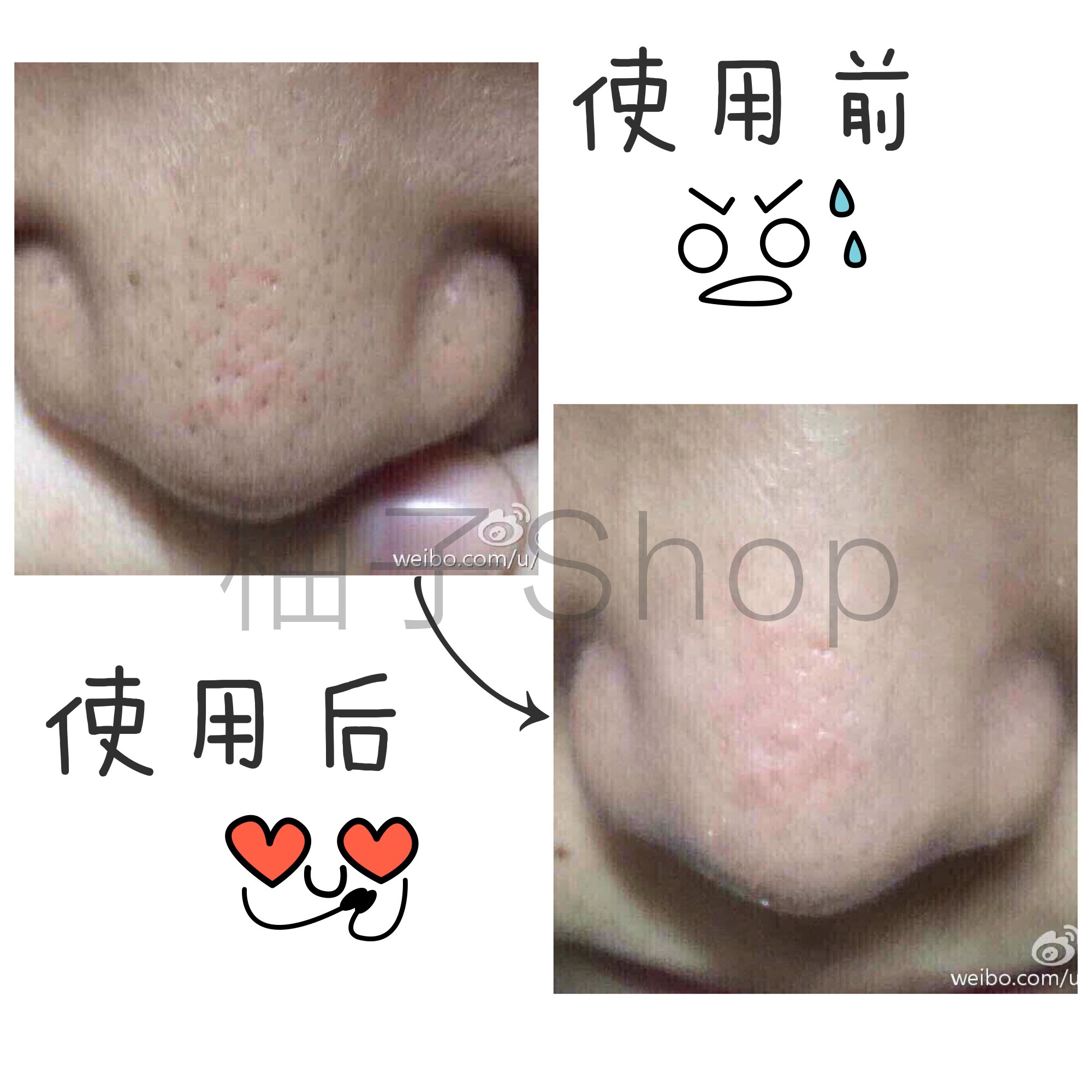 正品sheroching希罗黑头拜拜套装 去黑头白头粉刺导出