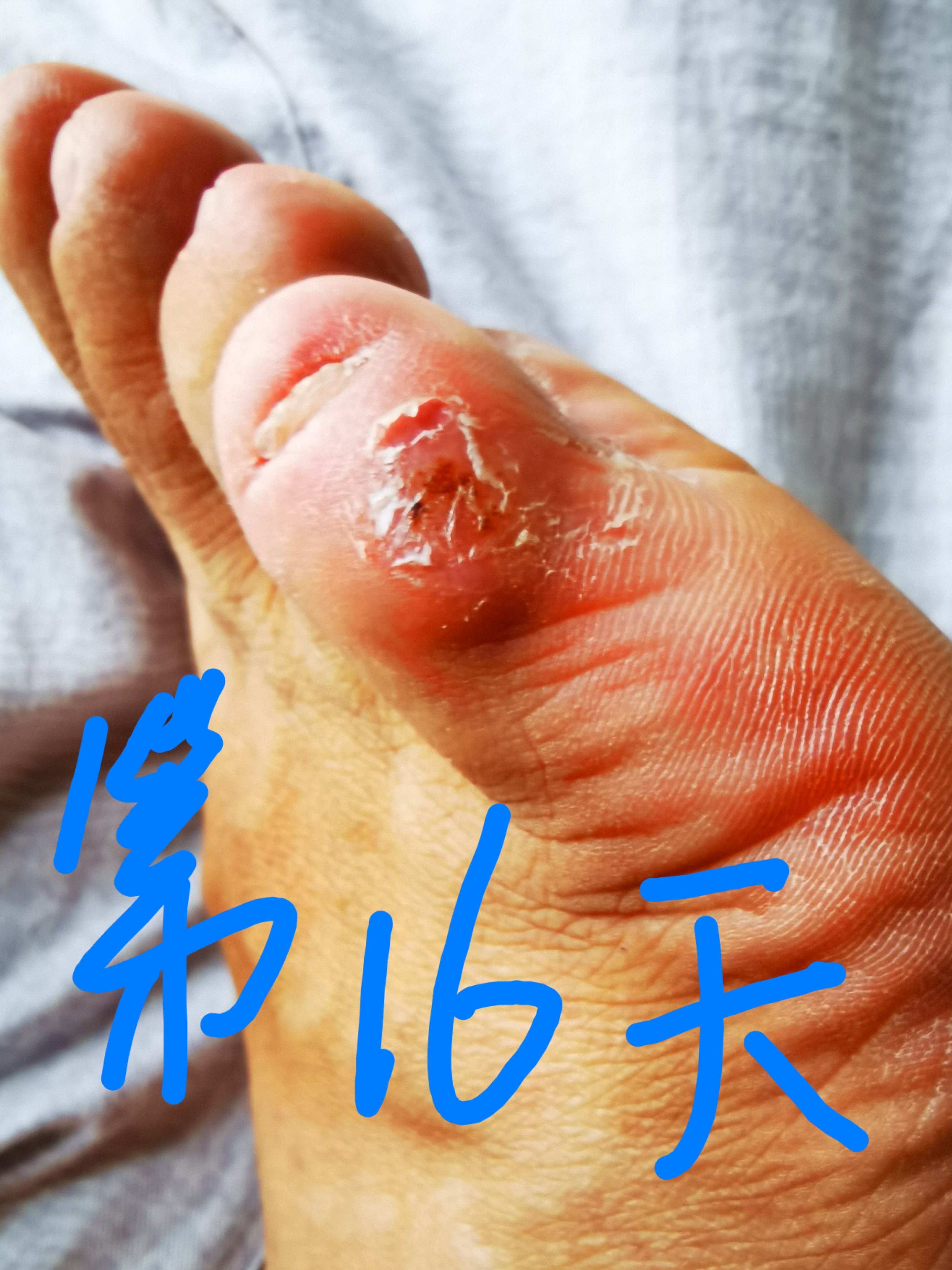 云南本草鸡眼贴鸡眼膏瘊子足部去脚底脚趾部跖疣灵老茧根肉刺