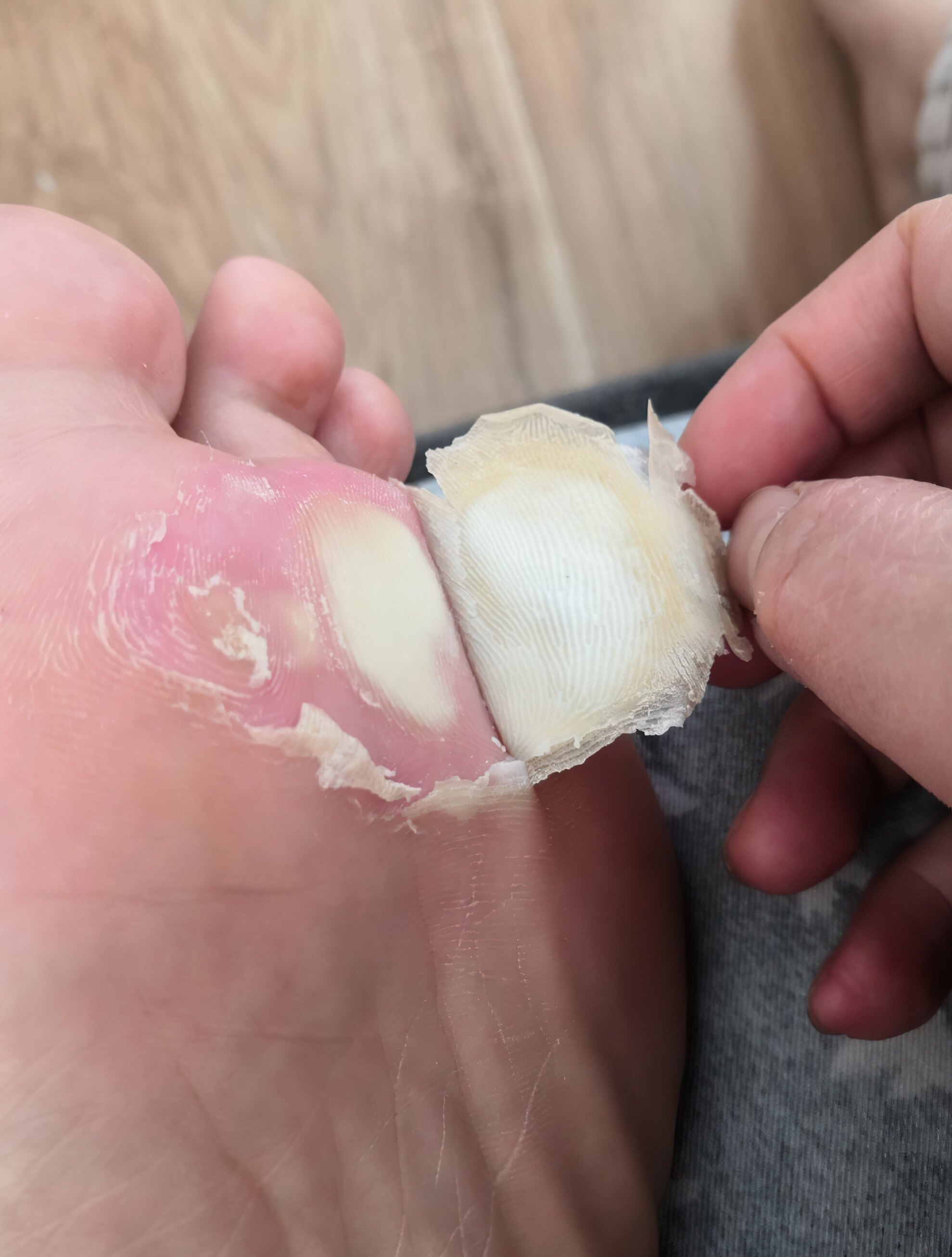 鸡眼贴鸡眼膏老茧肉刺肉粒脚丁瘊子跖尤刺窝死皮脚垫趾底手足专用