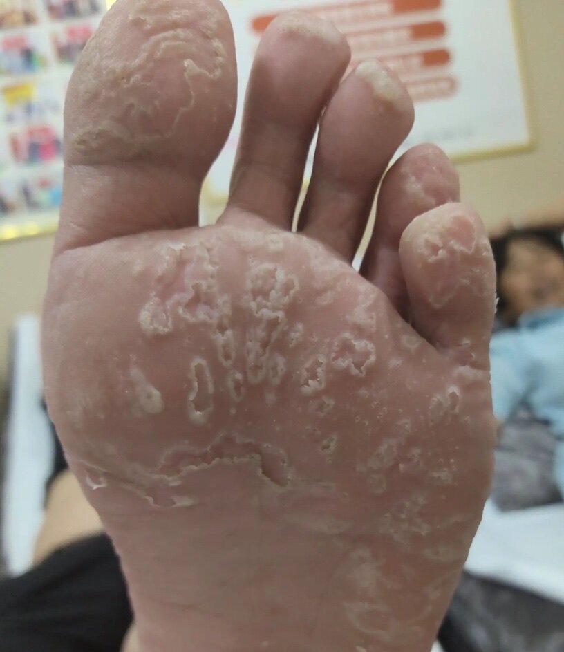 泡脚粉足光散去脚气脱皮止痒除臭正品根抑菌汗脚泡脚粉真菌感染臭