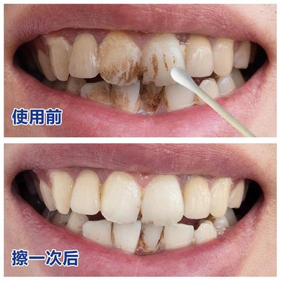 牙斑净去除烟渍美白牙齿清洁牙垢菌斑洗黑黄牙粉水液洁牙 6e0d1m5