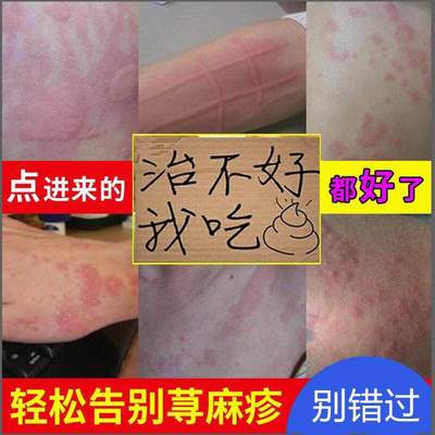 流感狂犬病脊髓灰質炎麻疹的癥狀主要傳播途徑預防措施_麻疹癥狀圖片_蕁麻疹癥狀以及皮膚變化