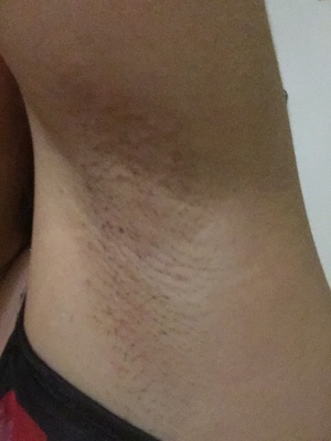 很疼&hellip;效果一般