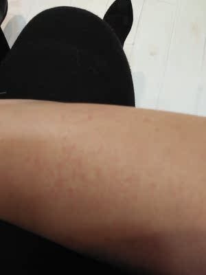 严重过敏，谨慎购买，