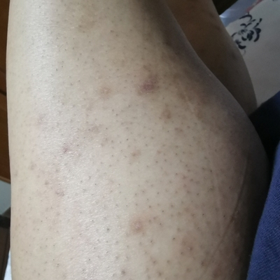 目前看来听弟妹说用慕金脱毛仪有危害吗，是否这个是误导啊？求证