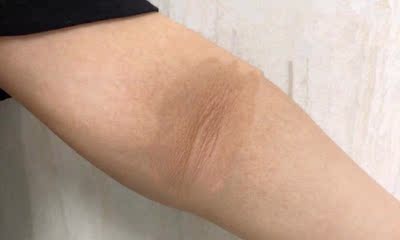 我是买回来用在手肘跟脚膝盖,今天用了第三瓶了前后拍了对比照手肘跟脚膝盖的黑色素已经去除了很多变白嫩了,平常除了在家里面才敢穿短衣短裤的,现在夏天都敢穿出门了 我是买回来用在手肘跟脚膝盖,今天用了第三瓶了前后拍了对比照手肘跟脚膝盖的黑色素已经去除了很多变白嫩了,平常除了在家里面才敢穿短衣短裤的,现在夏天都敢穿出门了