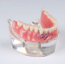 Dental Oral Section Materials New Plantings and Restoration Model 4 Nail Teaching Model Doctor-patient Communication Model