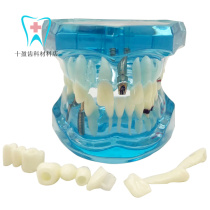 Dental Oral Teaching Blue Cultivation and Restoration Model Detachable teeth Pluccor Decayed Resistance Tooth Pathology