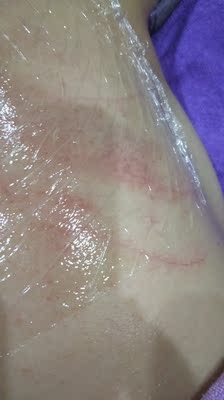 东西太刺了，本来想着先买一个试试如果可以就在买几个回来，没想到第一次用，既然把背给刮伤了，真不知道这产品不合格既然还能落到我们客人手里，可想而知，这东西的质量。我圈的这个位置就是多出的那块，用手摸上去多很刮手。第一次买到这东西。跟客服联系既然还说不是他们产品的问题，😓